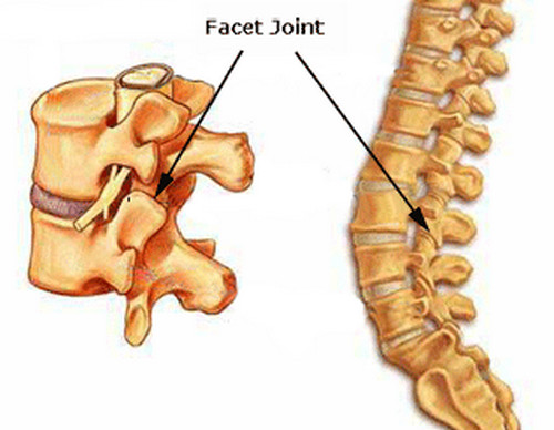 What is Facet Syndrome?